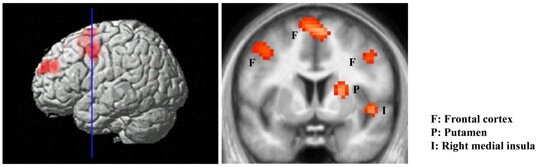 Brain scan showing the ‘hate circuit’
